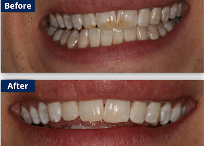 Replacement of Stained Fillings - Before & After