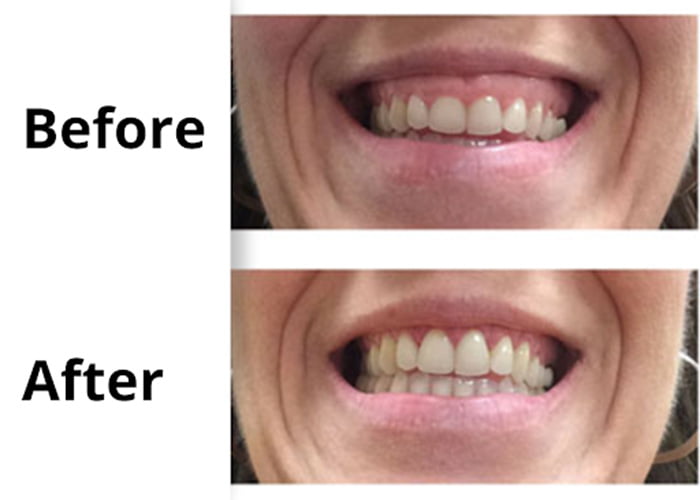 Lengthening of small and short teeth -Before and After