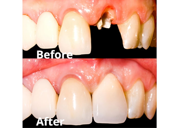 Repair of fractured tooth - Before and After