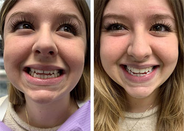 Teeth bonding before and after