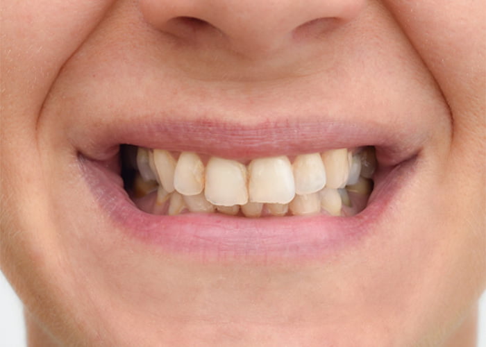 Improving the color of teeth and fillings with dental bonding - Before