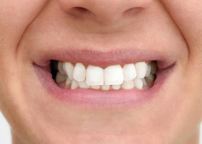 Improving the color of teeth and fillings with dental bonding - After