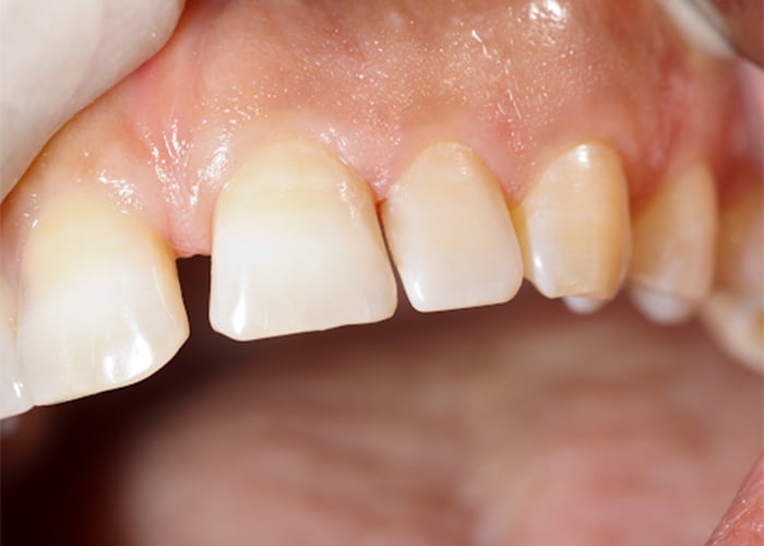 Reshaping Of Malformed Teeth With Dental Bonding - After