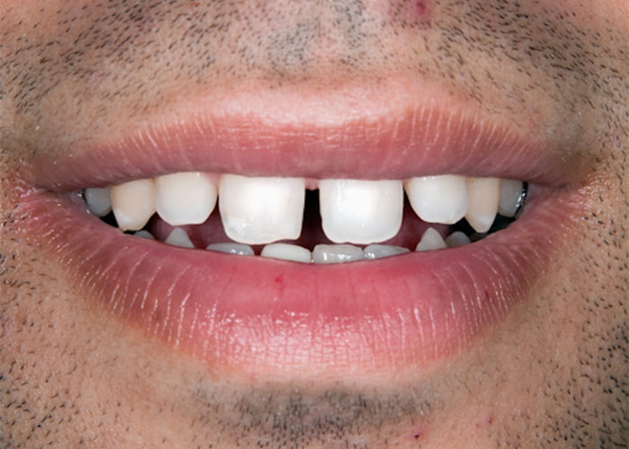 Diastema (gap or space) closure - Before