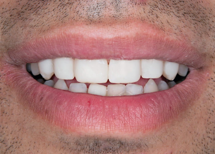 Diastema (gap or space) closure - Before