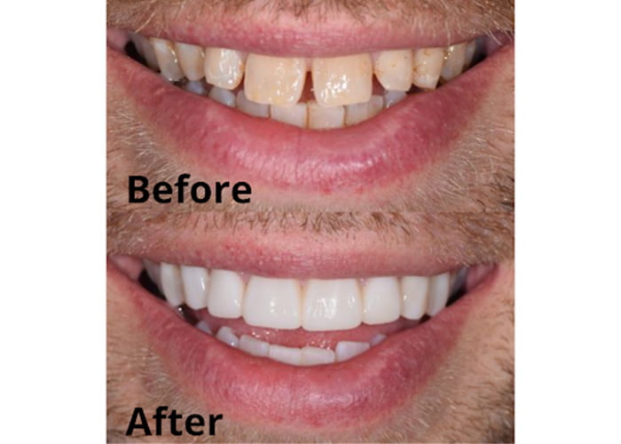 Composite Resin Bonding To Widen A Tooth And Close A Gap - Before & After
