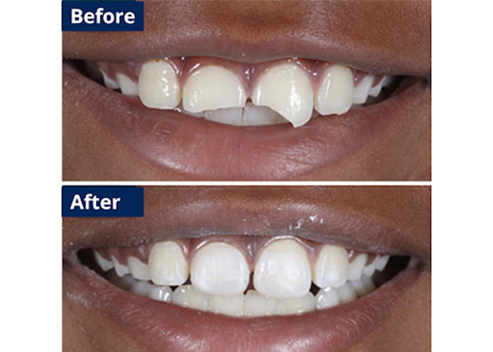 Emergency Repair Of A Fractured Tooth - Before & After
