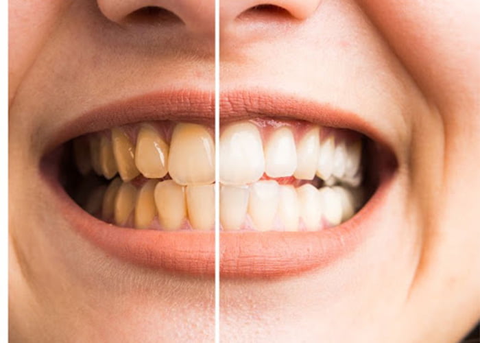 Teeth whitening at home remedies
