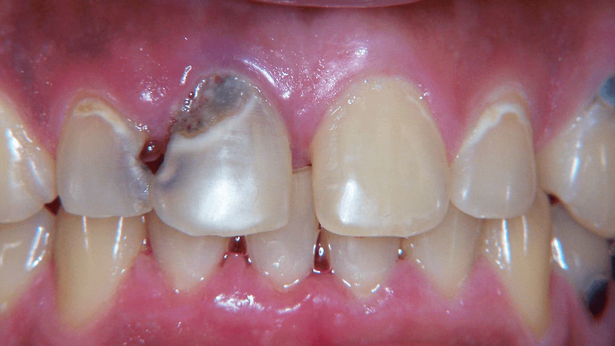 Cavities on front teeth