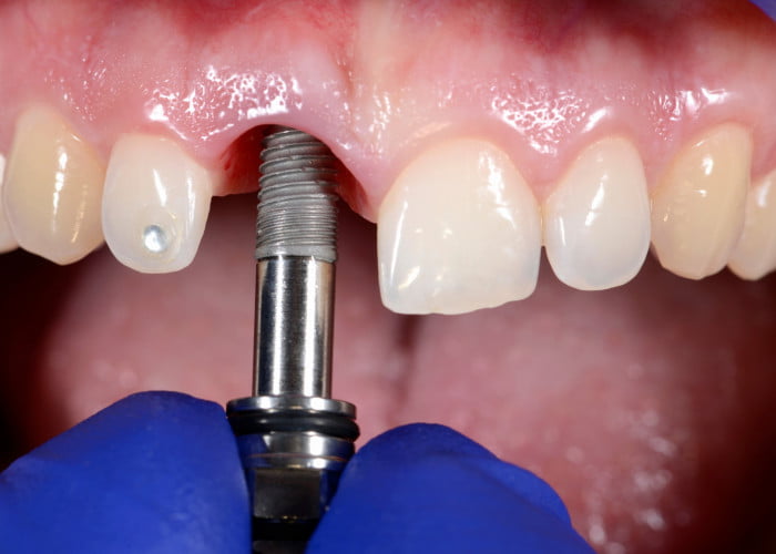 Dental implant healing stages