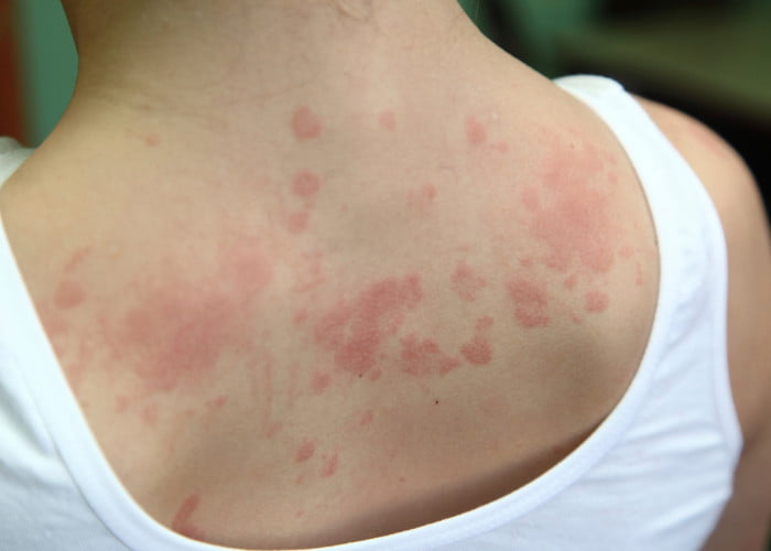 Foreign Body Rejection and Allergic Reaction