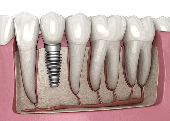 How long do dental implant last