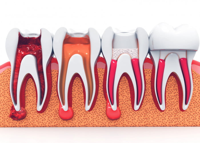 Factors That Affect The Lifespan Of Your Root Canal