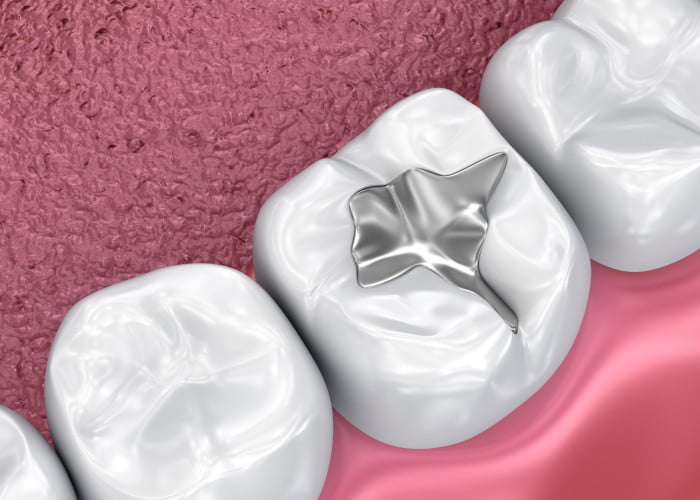 Consider Dental Sealants
