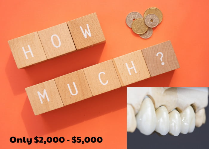 Dental Bridge Typically Cost