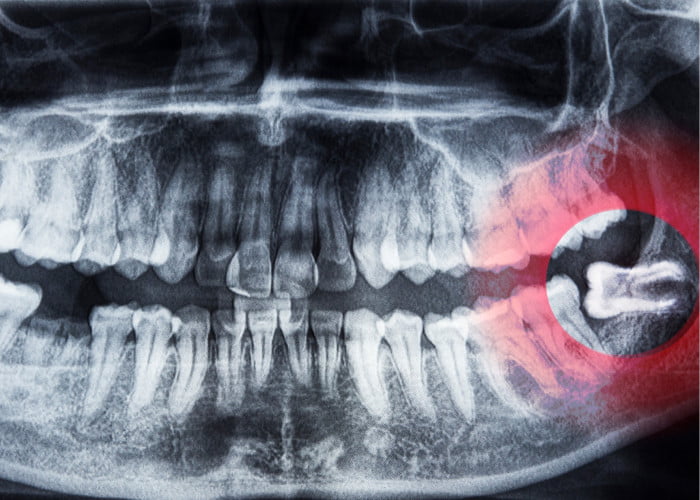 What should you do if you have a wisdom tooth cavity?