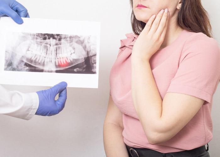 When must a wisdom tooth with a cavity be considered for removal?
