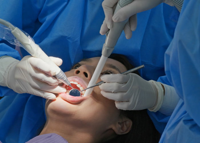 When can the wisdom tooth cavity be repaired by placing a dental filling?