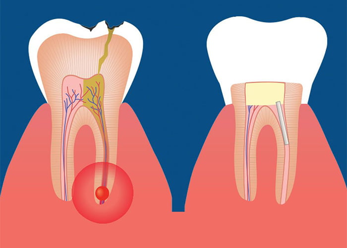Treatments for Cracked Teeth After Root Canal