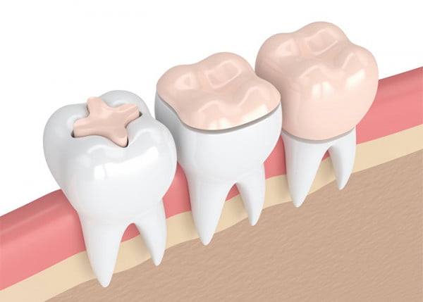 Dental Crown vs Filling: When to Choose Which