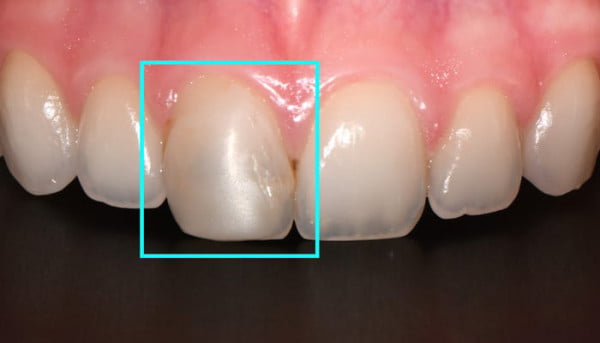 Composite fillings 2025 front teeth