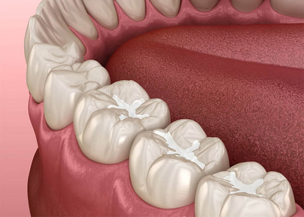 What Else Impacts How Long Your Fillings Last?