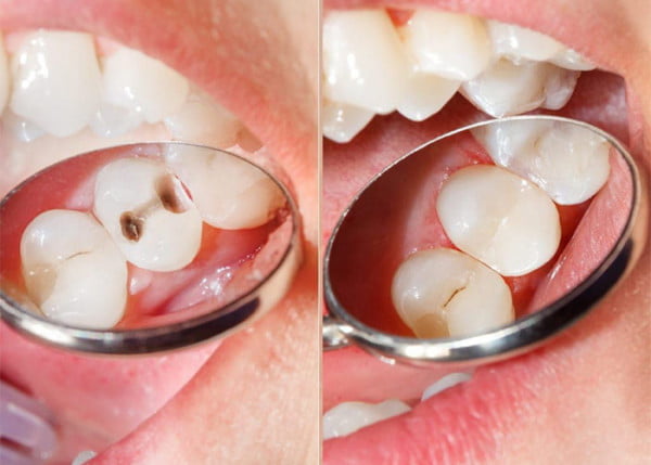How Long Do Dental Fillings Last