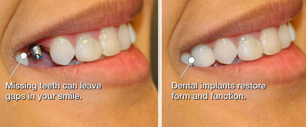 What Affects the Lifespan of Dental Implants?