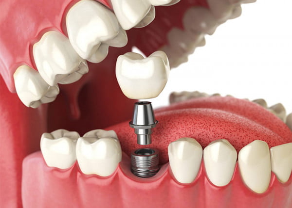 The Average Lifespan of Dental Implants