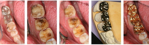How Long Do the Different Kinds of Fillings Last?