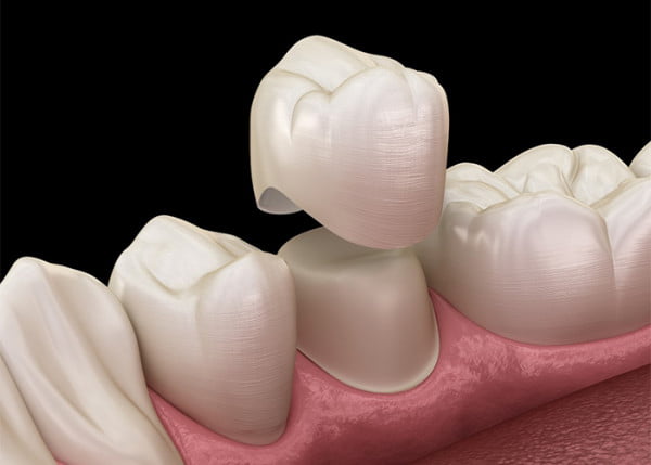 What are dental crowns?