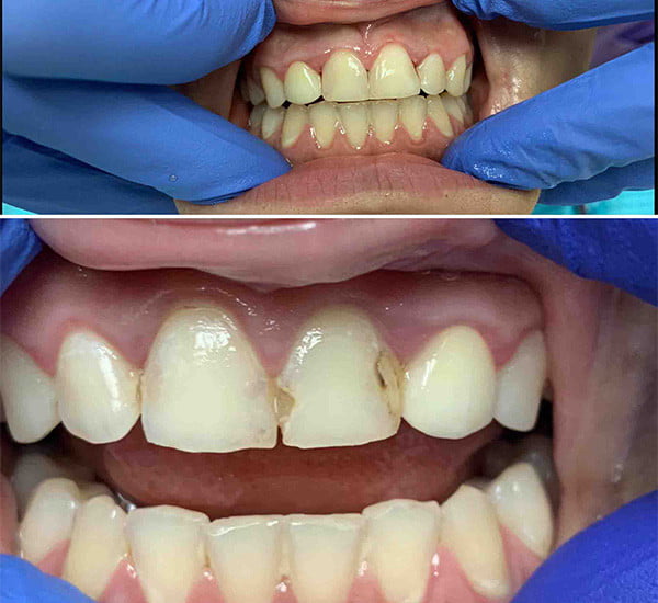 Getting a Filling on Front Teeth: Before and After
