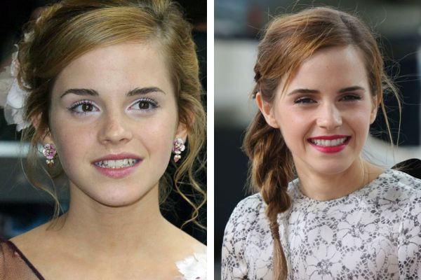 emma watson before and after braces