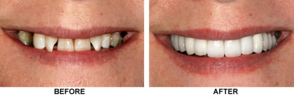 The Role of Crowns Teeth Before and After Comparison