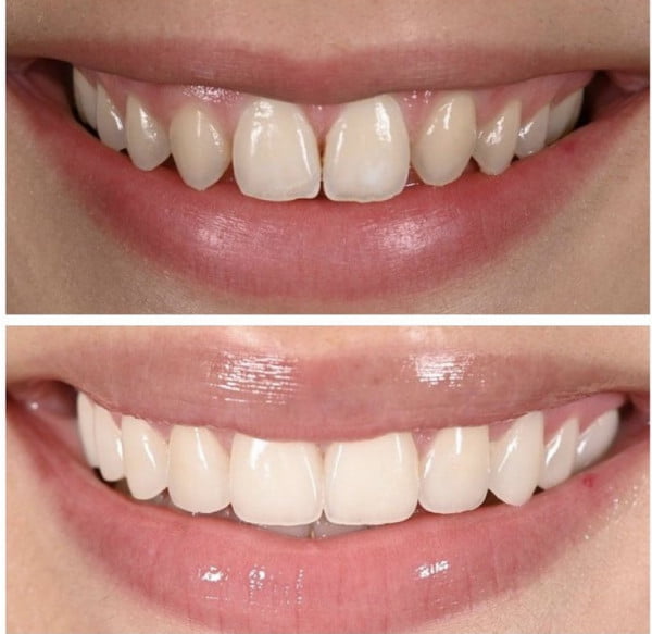 Teeth Crown Materials Before and After Impact