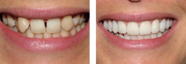crown-teeth-before-and-after-dentist-for-life