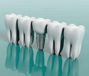 Choosing the Right Dental Insurance for Implants
