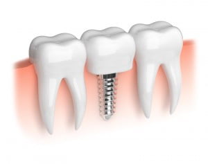 Understanding Dental Implant Insurance Coverage