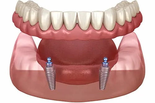 Maintaining Your Snap-In Dentures for a Lifelong Smile