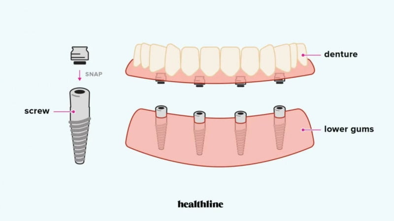 Advantages of Snap-In Dentures