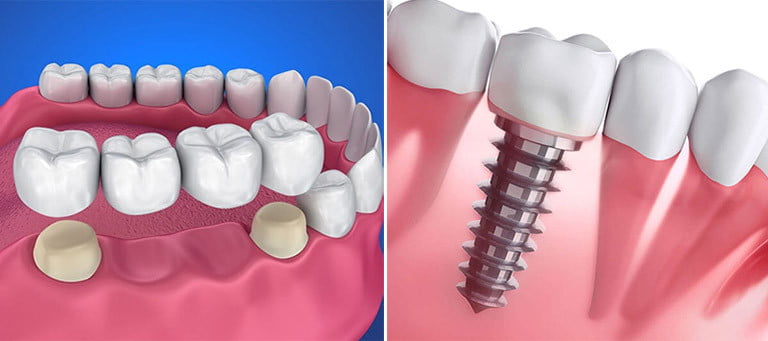 implant-and-dentures