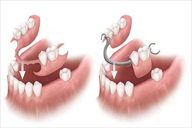 The benefit of implants vs. dentures 