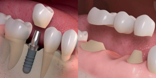 implant-and-dentures-ava