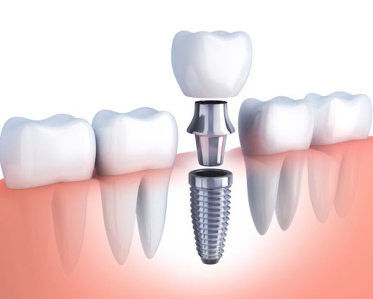 Is Same-Day Dental Implant Right for You?