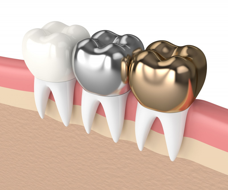 Advantages of Silver Teeth Crown