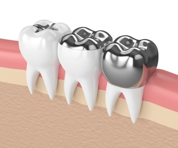The silver teeth crown process