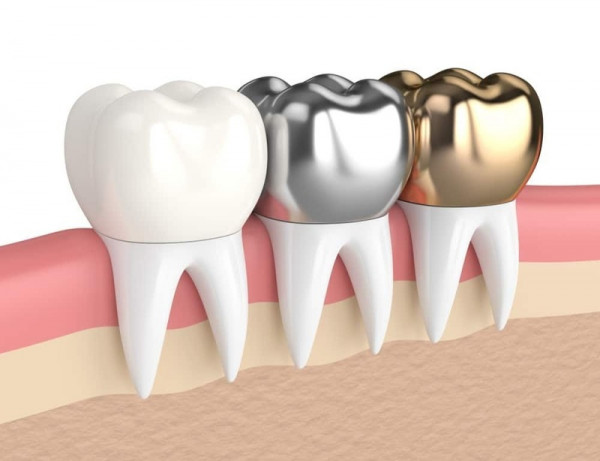 Understanding the Need for Crowns Teeth